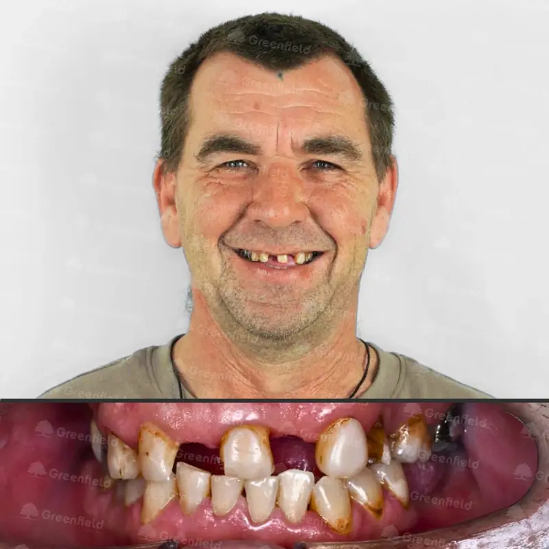 Trước điều trị: Implant Dentium với mão sứ zirconia