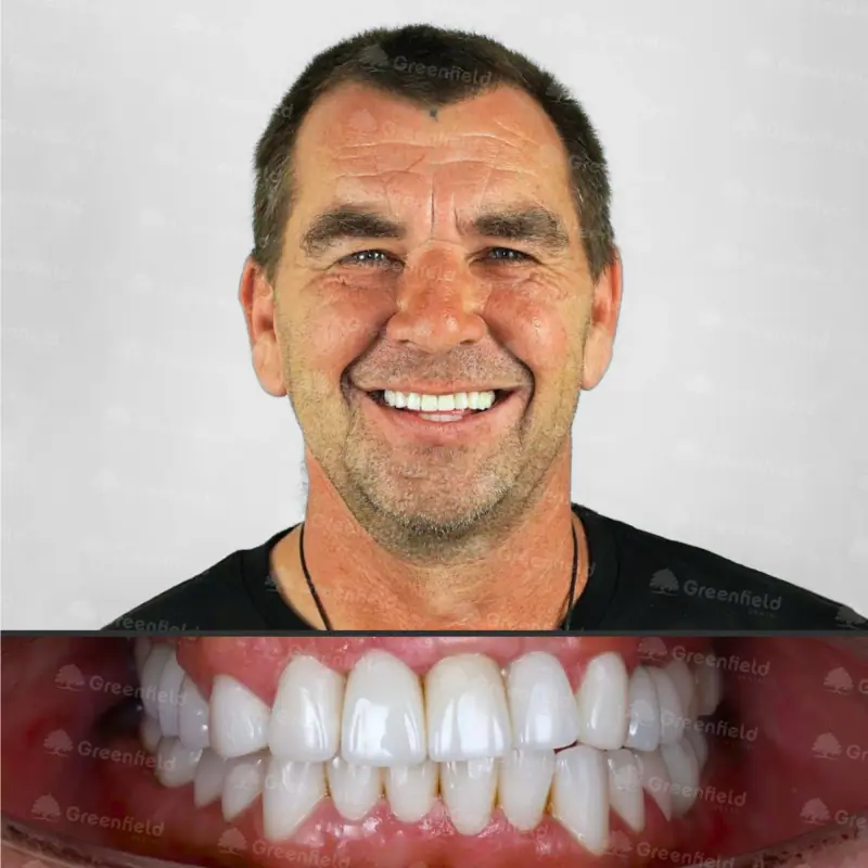Sau điều trị: Implant Dentium với mão sứ zirconia