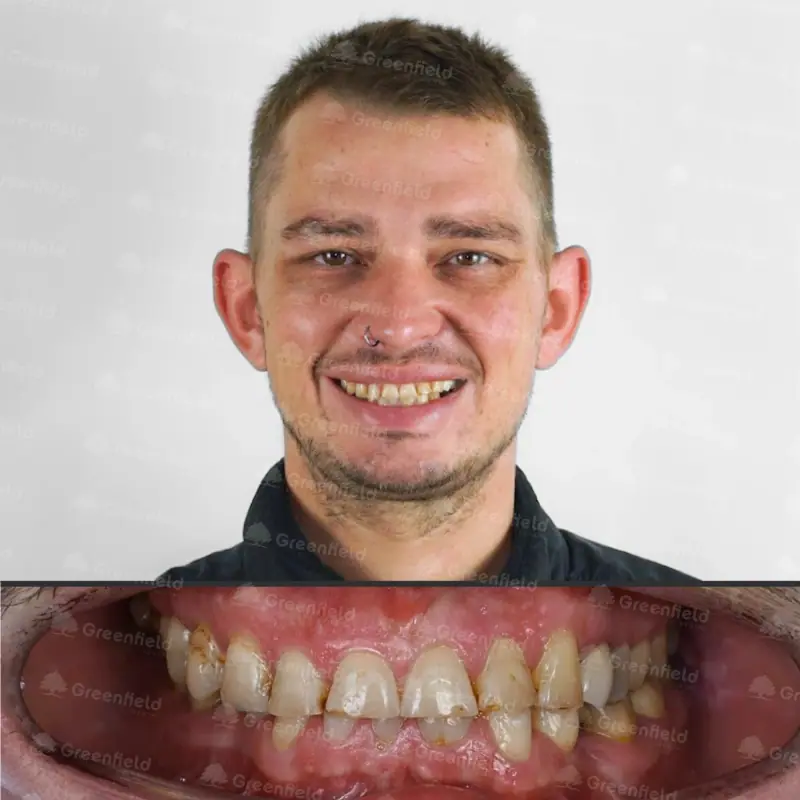 Trước điều trị: Mòn răng nặng kèm ê buốt