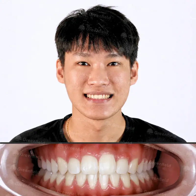 Sau điều trị: Cắn chéo răng cửa kèm khớp cắn đối đầu