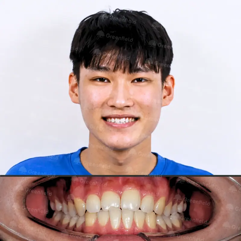 Trước điều trị: Cắn chéo răng cửa kèm khớp cắn đối đầu